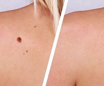 Электрохирургическая коагуляция доброкачественных образований кожи  1 штука до 0.5 см в диаметре - alwento.ru – Екатеринбург