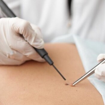 Электрохирургическая коагуляция и деструкция папиллом до 2 мм без учёта биопсии  до 3 штук - alwento.ru – Екатеринбург