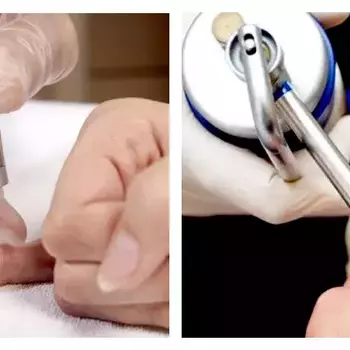 Криодеструкция бородавки, остроконечной кондилломы, контагиозного моллюска в интимной зоне 1 штука до 2 мм в диаметре - alwento.ru – Екатеринбург